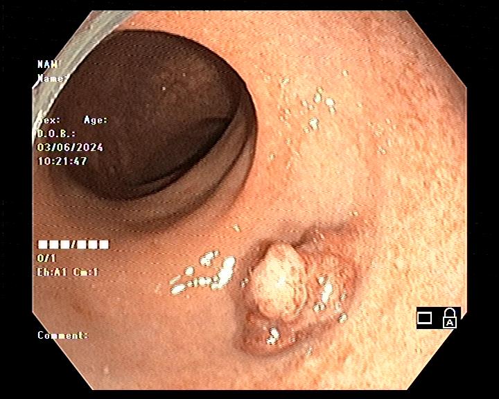 POLYP ĐẠI TRÀNG NÊN CẮT HAY ĐỂ THEO DÕI
